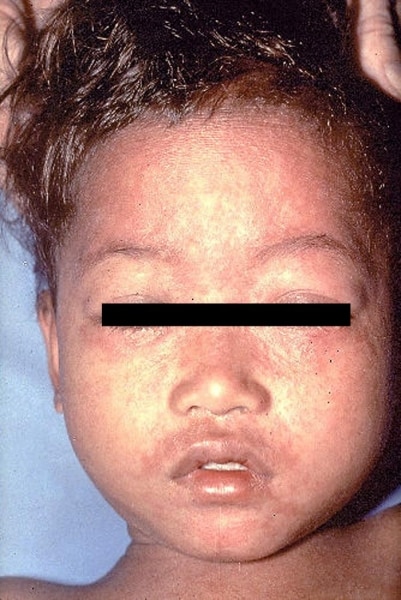 measles booster, measles, dr berry pierre, measles vaccine, measles death rate, measles outbreak,measles symptoms