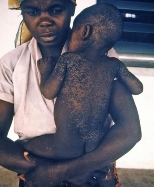 measles booster, measles, dr berry pierre, measles vaccine, measles death rate, measles outbreak,measles symptoms