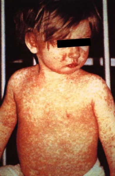 measles booster, measles, dr berry pierre, measles vaccine, measles death rate, measles outbreak,measles symptoms